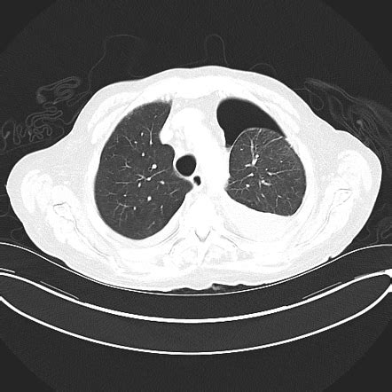 Trapped lung | Radiology Case | Radiopaedia.org