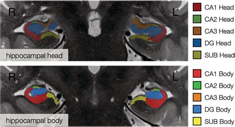 Example Of Hippocampal Head And Body Subfield Segmentations The