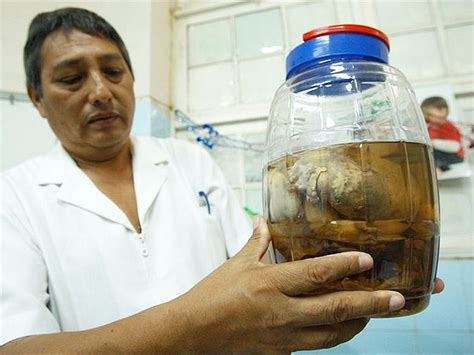 Operaron Con éxito En Perú Al Niño Que Tenía Un Feto En El Abdomen