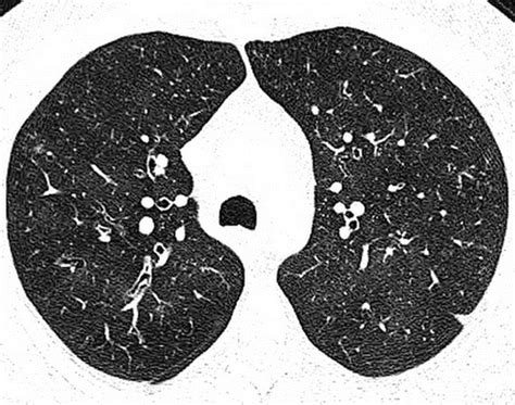 Classification Of Diffuse Lung Diseases Why And How Radiology