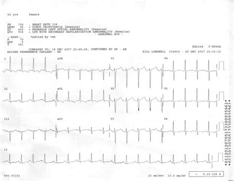 Endocarditis Ecg