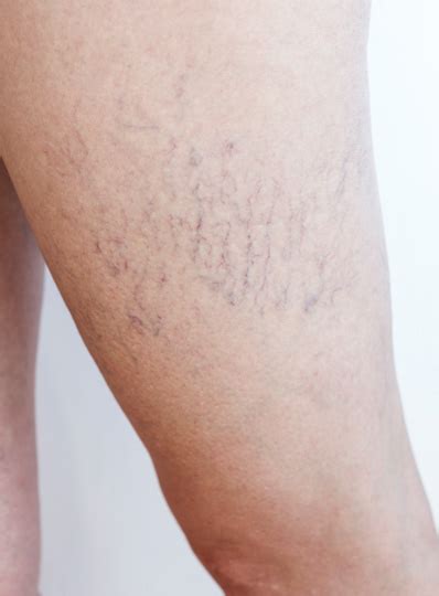 Spider Veins Vein Conditions Triangle Vein Clinic Cary Nc