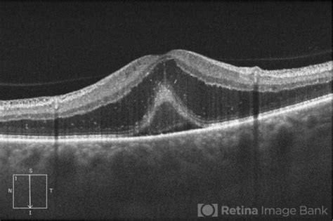 Optometry Atlas Optic Nerve Conditions Viewpoint