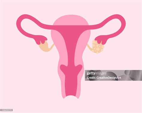 Polycystic Ovary Syndrome Female Reproductive System With Ovarian Cysts