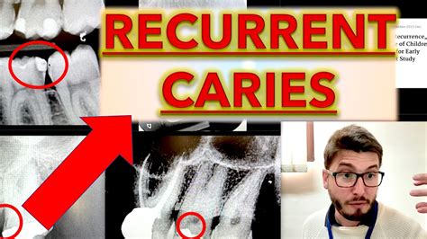 Recurrent Caries For Beginners Decay On Dental X Ray Cavity Teeth