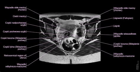 Miednica (kobieta) : normalna anatomia | e-Anatomy