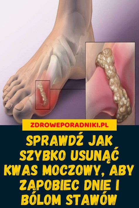 37 Kwas Moczowy Ideas Kwas Moczowy Dna Moczanowa Naturalne Zdrowie