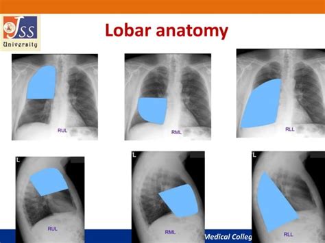 Chest x ray basic interpretation | PPT