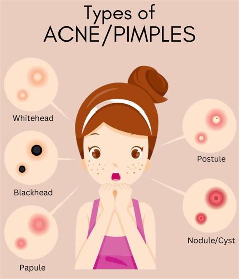 How to tackle and treat acne / pimples? - SkinQure