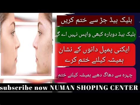 Blackhead Removal Blackheads Kaise Nikale Blackheads Treatment