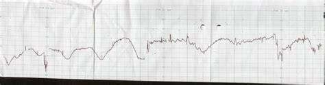 Nonstress Test Indicating Prolonged Fetal Heart Deceleration Download Scientific Diagram