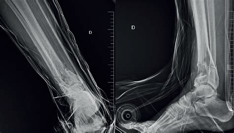 Tratamiento De La Osteomielitis Crónica Mediante La Técnica De Las