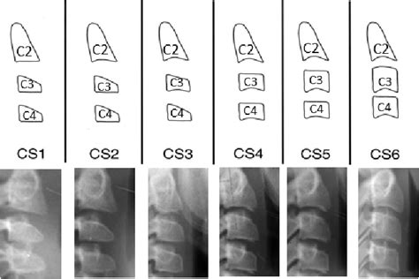 Figure 2 From Classification Of The Cervical Vertebrae Maturation CVM