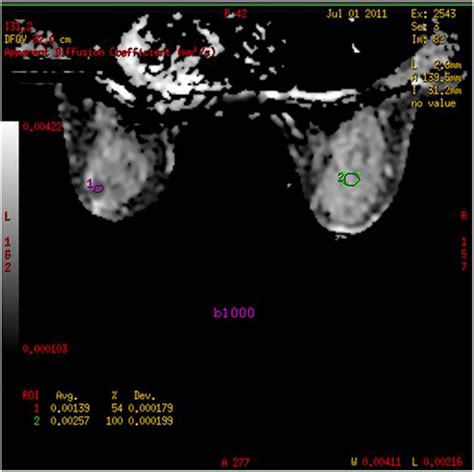 Impact Of Fibroglandular Tissue And Background Parenchymal Enhancement