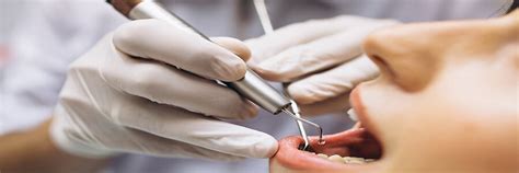 Dişler Neden Çekilir? | Klinik Artı Blog