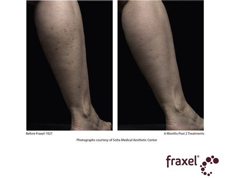 FRAXEL LASER | FOLSOM DERMATOLOGY | FOLSOM, CA