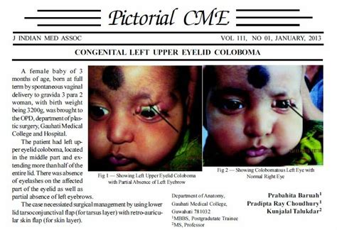 (PDF) Congenital left upper eyelid coloboma