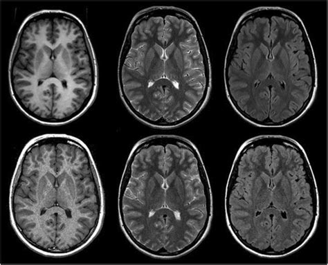 From Left To Right T1 T2 And Flair Weighted Conventional Top Row