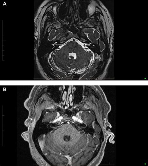 retrocochlear lesion mri