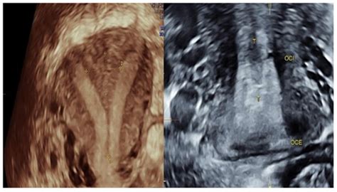 A Successful Pregnancy Outcome in a Complete Septate Uterus