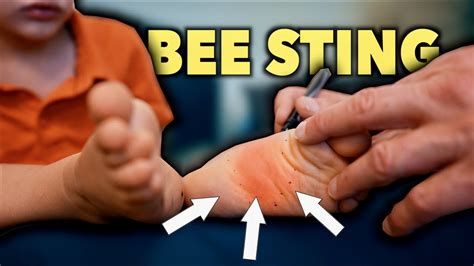 What To Do For A Bee Sting On Foot Sale Online