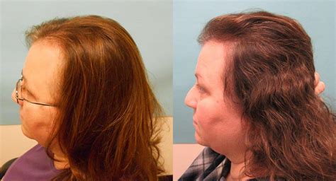 Female Hair Loss Treated with Oral Finasteride - Hair Transplant Case ...