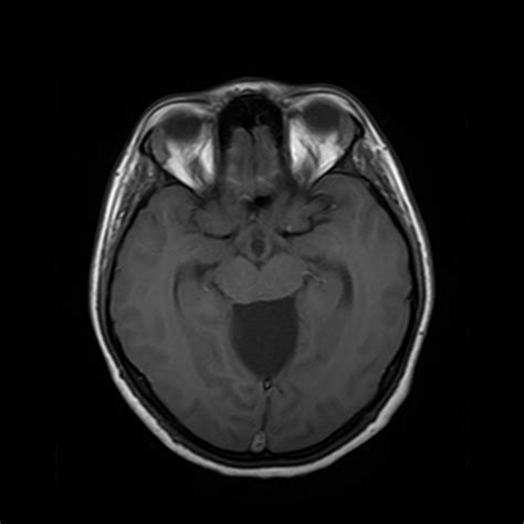 Quadrigeminal Cistern Arachnoid Cyst Image