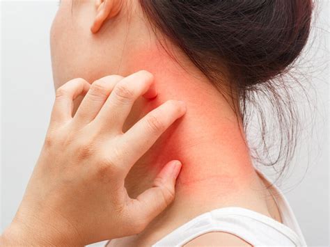 AtenciÓn ¿qué Es La Dermatitis Atópica