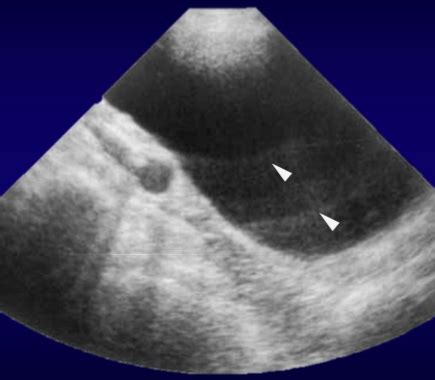 Ultrasound Physics Artifact Flashcards Quizlet