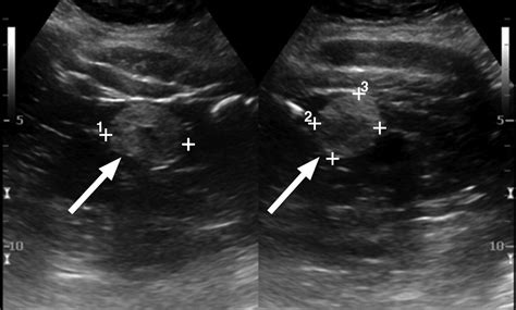 Comprehensive Imaging Manifestations Of Tuberous Sclerosis Ajr