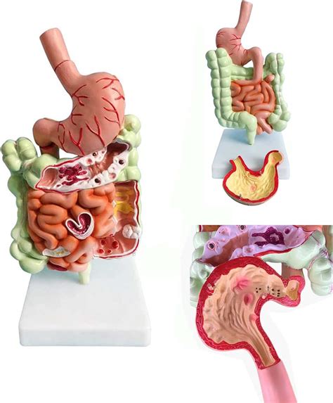 Human Colon Disease Model Gastrointestinal Anatomy Model Internal