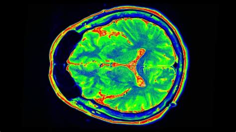 Exploraci N Del Cerebro De Miri Humano En Fondo Negro Tomograf A