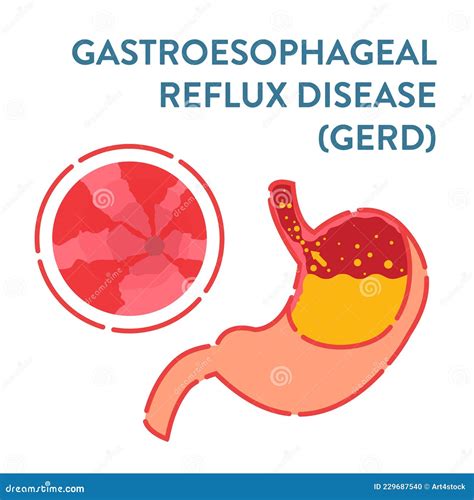 Gerd Stomach Disease Detected By Endoscopy Procedure Stock Vector