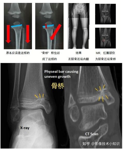 骨折影像诊断（2） 知乎