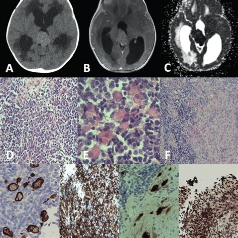 A Contrast Enhanced Axial Computed Tomography Ct Scan Identified A