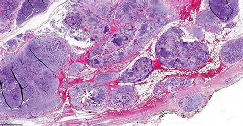 Pleomorphic Adenoma Pathology