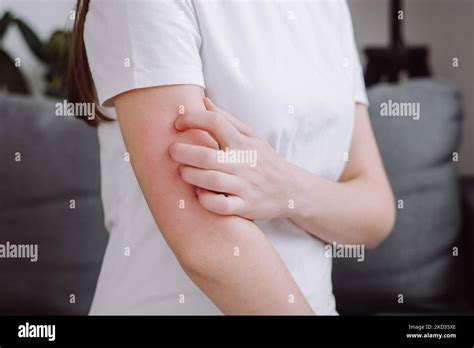 Close Up Of Annoyed Unhealthy Young Female Itching On Her Arm Have Red