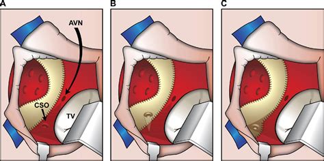 Catheter Ablation In Transposition Of The Great Arteries With Mustard