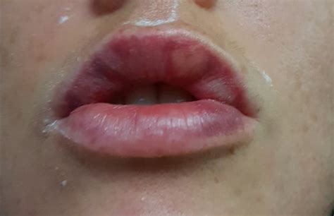 White Lumps In Lips After Filler | Lipstutorial.org