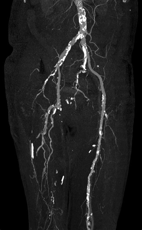 Abdominal Aorta Calcification Ct … Bild Kaufen 12641633 Science