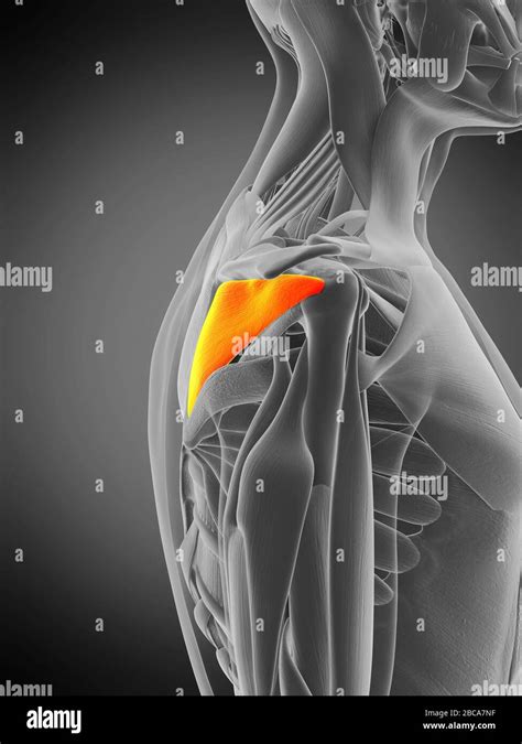 Distal Infraspinatus Tendinopathy