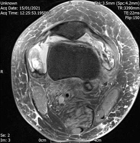 Knee Synovitis | Cases - Home