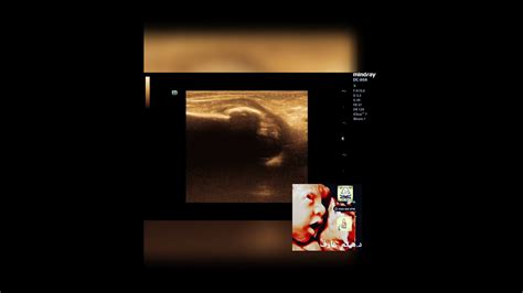 Fracture Humerus With Callus In Elbow Ultrasound By Dr Haissam Aref Dms Msc Md Ultrasound