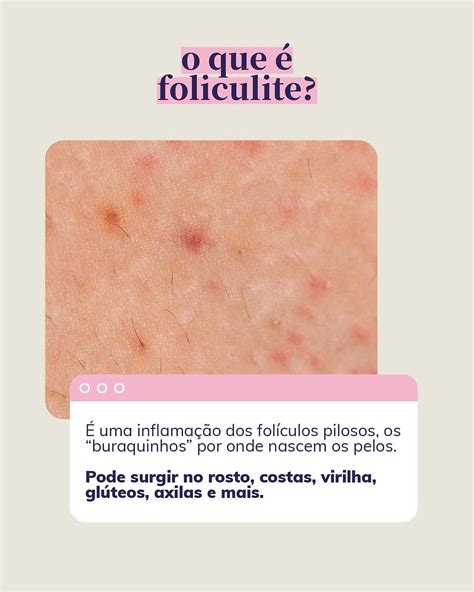 Gillette Que Nao Da Foliculite - Dermaclub | Bora falar sobre Foliculite? Não é tão comum comentar, mas ...