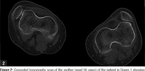 Congenital Dislocation Of The Patella Semantic Scholar