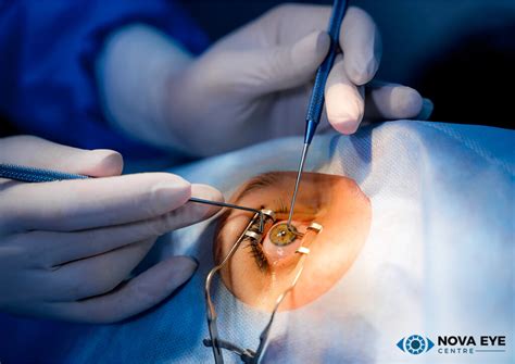 Preparing For Eye Surgery Tips And Recovery Nova Eye Centre