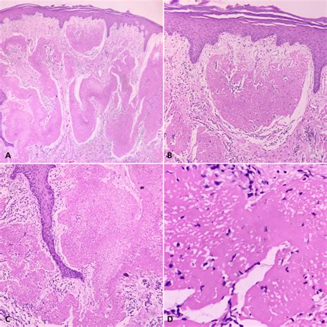 Gingival Swelling As A First Sign Of Clinical Presentation Of Ligneous