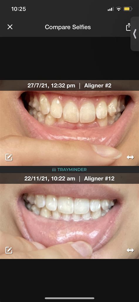 4 Months Progress Invisalign