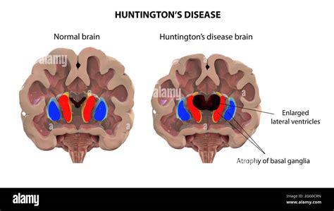 Huntington’s disease brain hi-res stock photography and images - Alamy