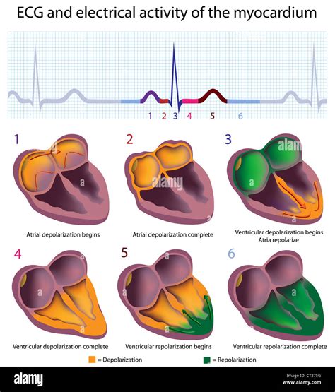 Myocarditis Ecg Dr Smiths Ecg Blog Ecg Of Pneumopericardium And